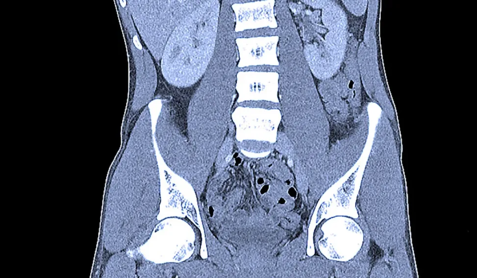 Is CT Scan Contrast Dangerous