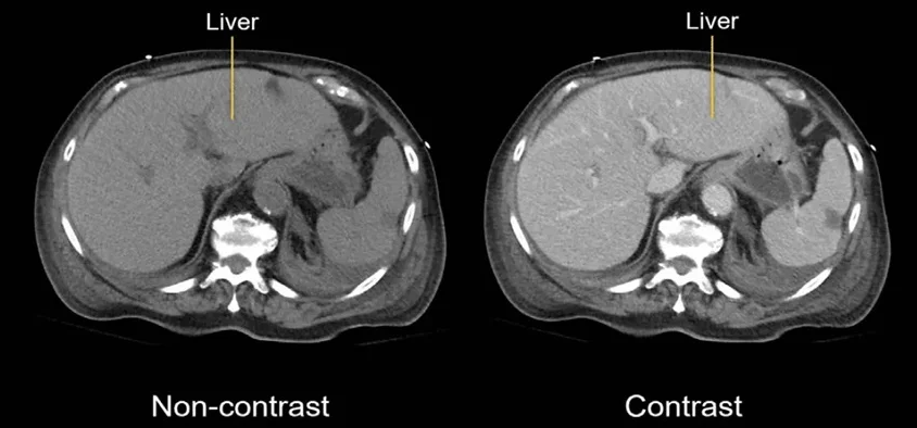 CT Scan Contrast